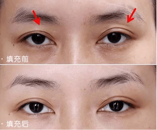 玻尿酸丰眼窝