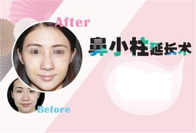 手术延长鼻小柱