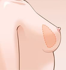 乳头内陷矫正