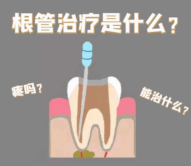 根管治疗