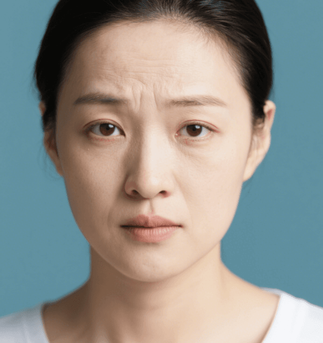 自体脂肪去抬头纹