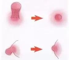 乳头缩小