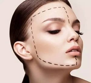 V-LINE瓜子脸手术