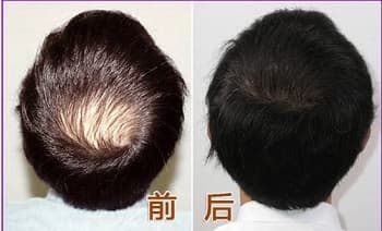 头顶加密种植