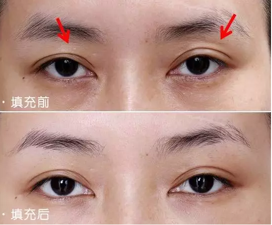 玻尿酸丰眼窝
