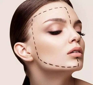 V-LINE瓜子脸手术